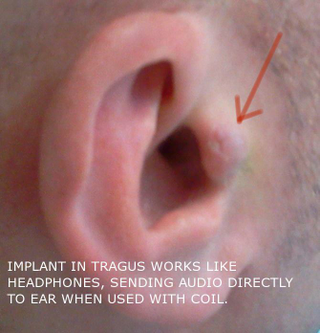 Illustration for article titled Implanted headphones!